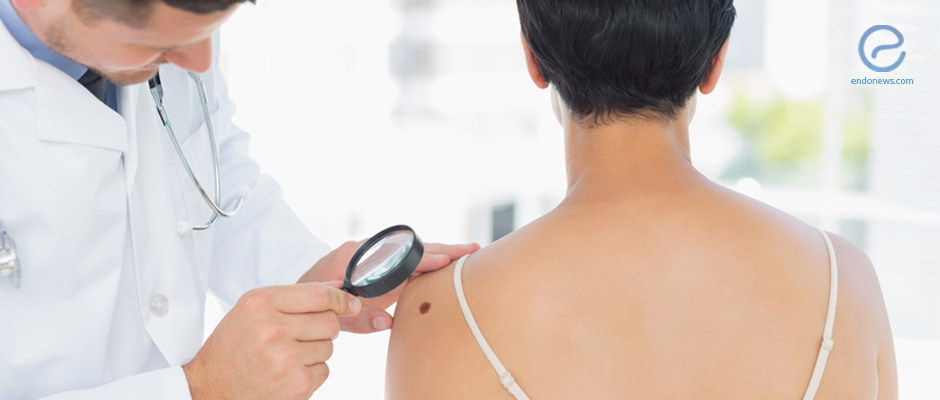 Does endometriosis increase skin cancer risk? 