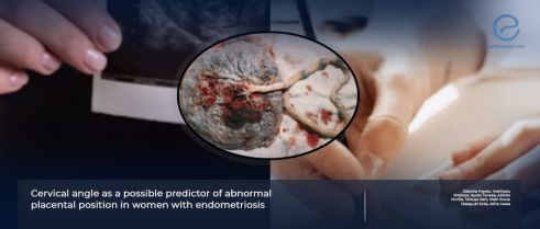 Cervical angle, retroflex uterus and abnormal placental position in women with endometriosis