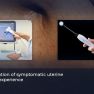 Management of uterine adenomyomas with percutaneous cryoablation.