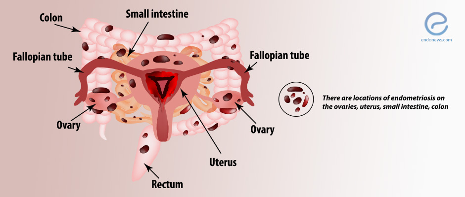 bowel endometriosis symptoms