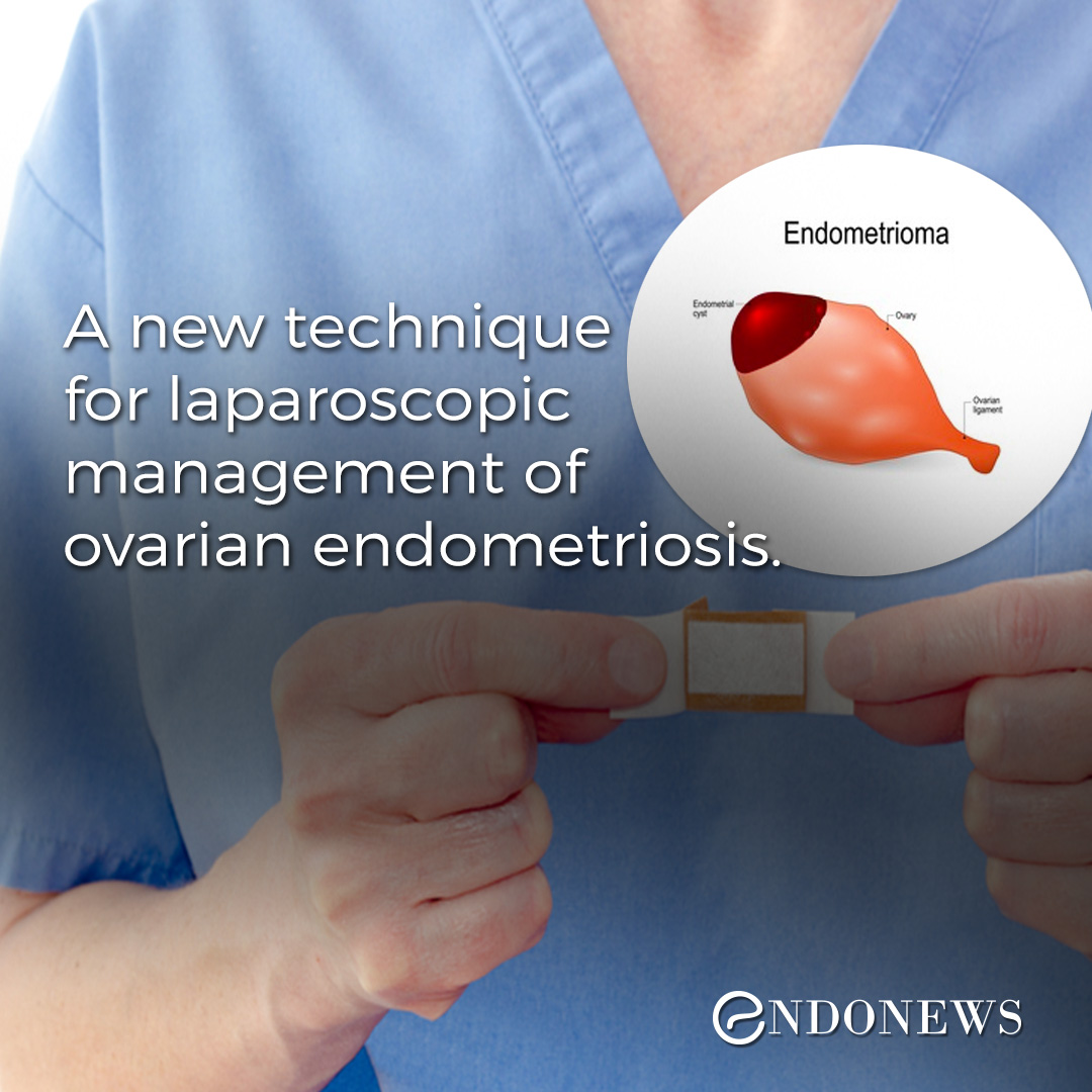 A New Technique For Laparoscopic Management Of Ovarian Endometriosis Endonews