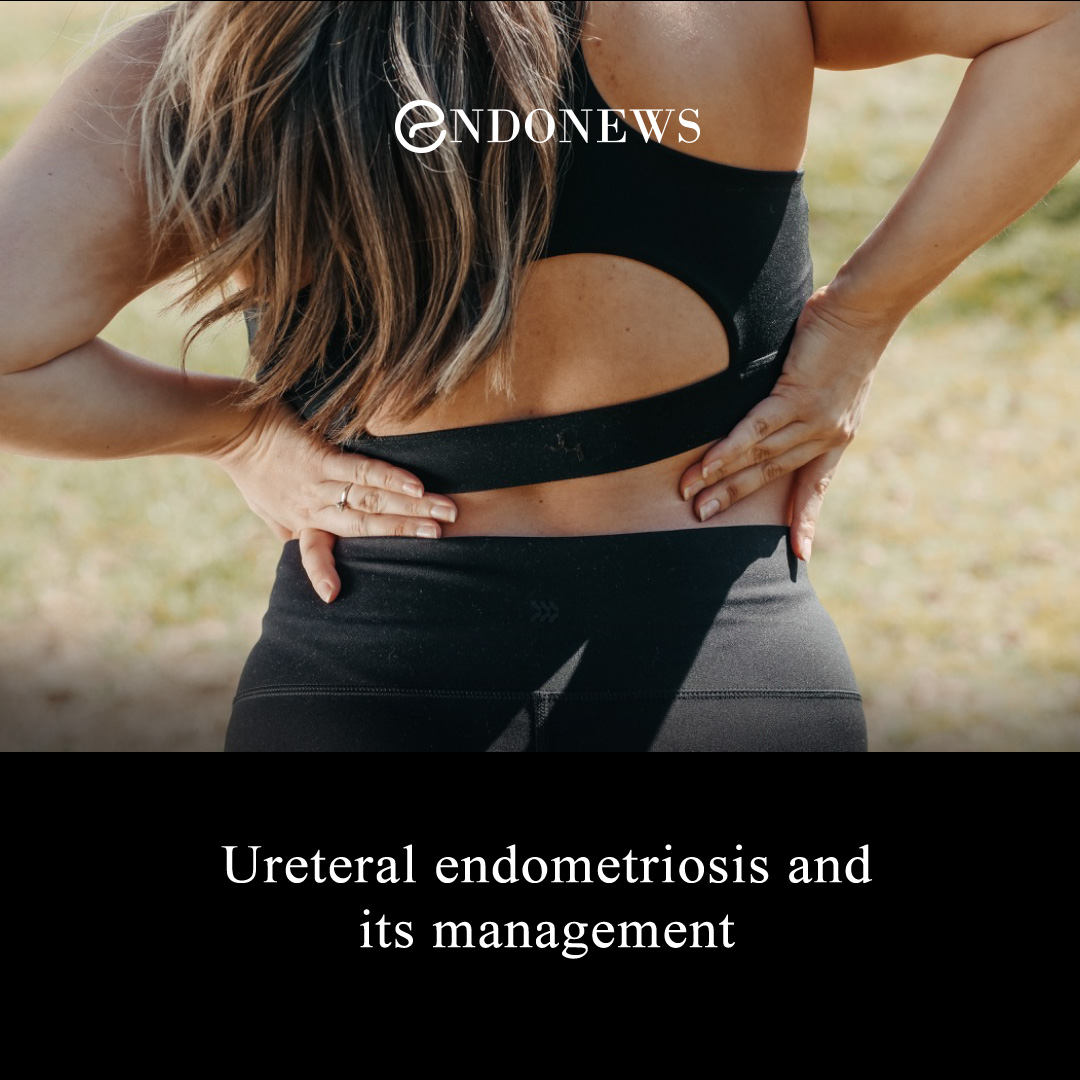 Ureteral Endometriosis And Its Management Endonews 5335