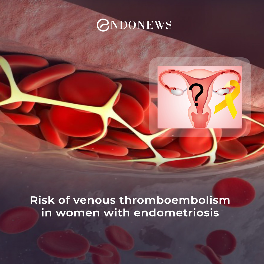 The Association Between Severe Endometriosis And Venous Thromboembolism Endonews 5944