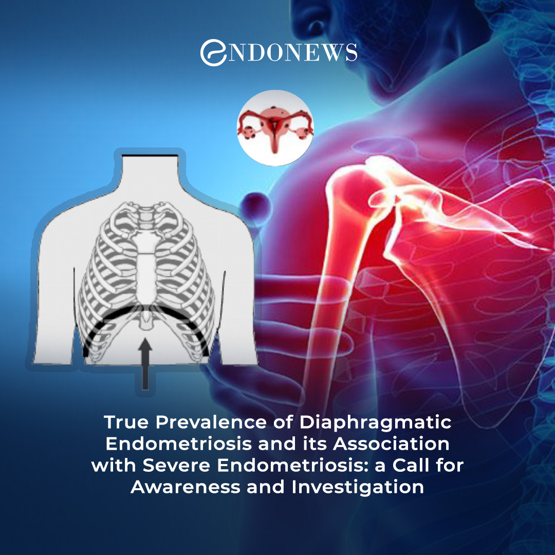 Diaphragmatic Endometriosis a Call for Awareness EndoNews