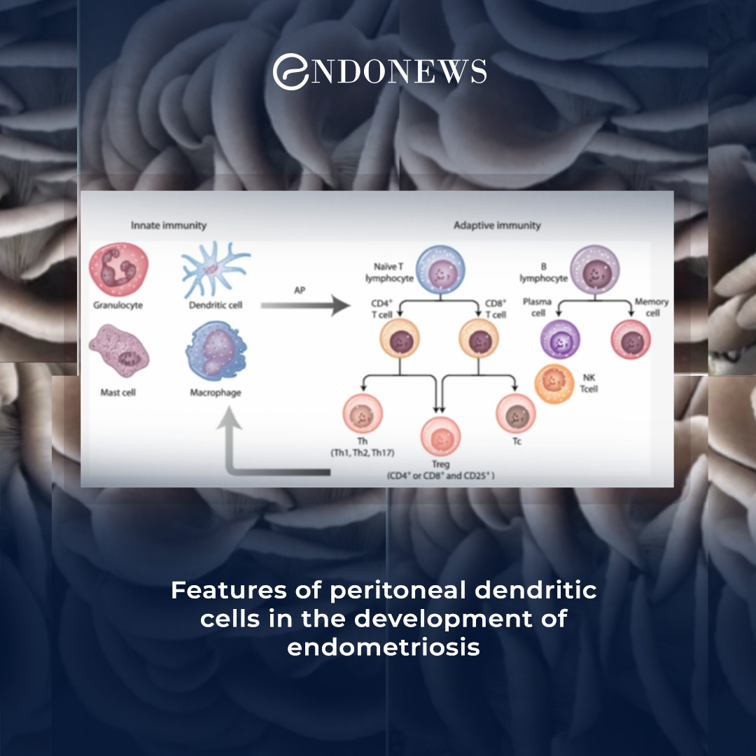 Role of peritoneal dendritic cells in endometriosis development | EndoNews