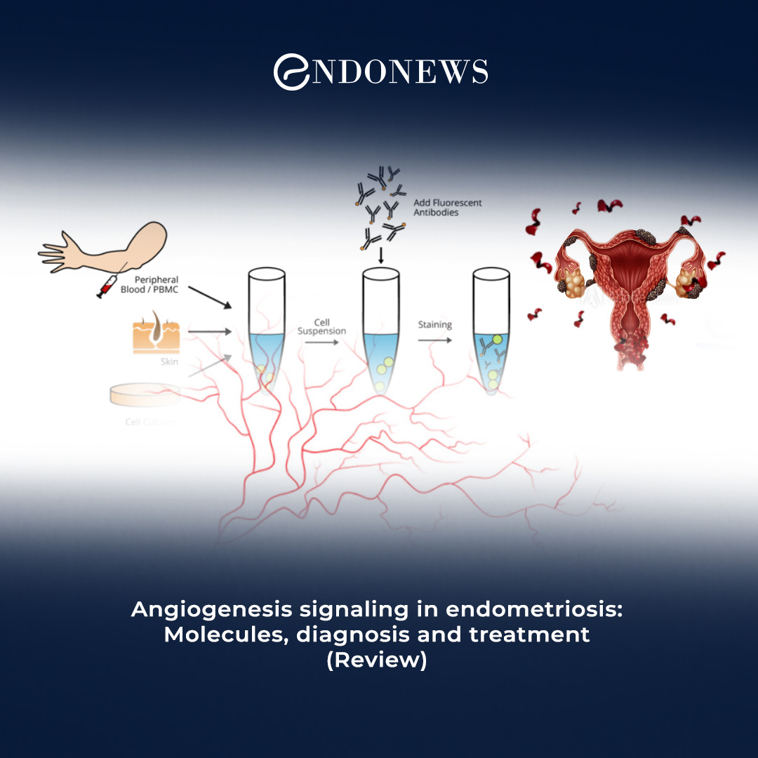 Hot Research In Endometriosis; New Vessel Formation: Angiogenesis 