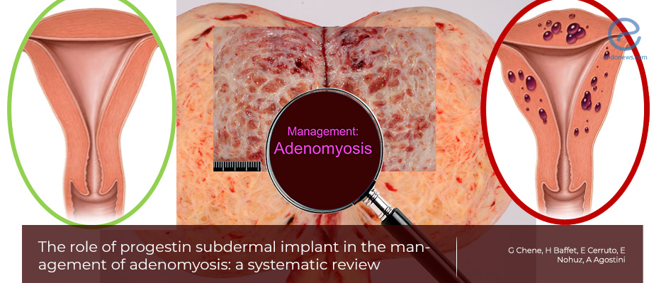A comprehensive review of subdermal progestin in adenomyosis management