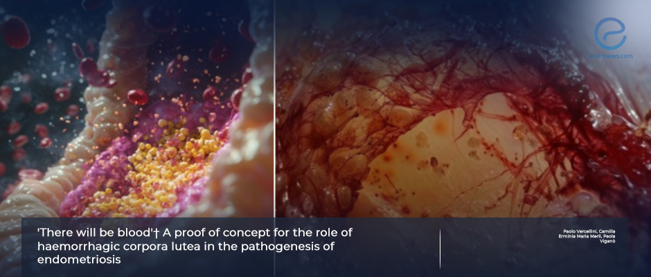 A new pathogenetic hypothesis of endometriosis 