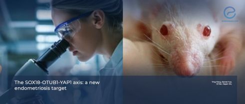 Uncovering a New Molecular Driver in Endometriosis