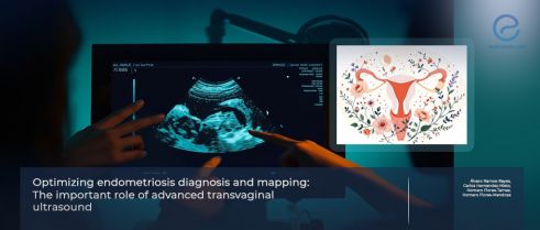 Advanced Transvaginal Ultrasound for Endometriosis Mapping