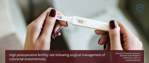 IVF Is the Best Option to Become Pregnant for Women with Severe Endometriosis, or Is It Not?