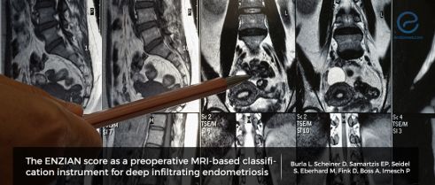 MRI-based