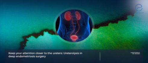 Key Aspects of Ureterolysis in deep endometriosis surgery