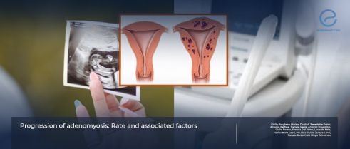 Study Identifies Factors Associated With the Risk of Adenomyosis Progression 