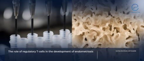 Regulatory T cells influence on endometriosis development