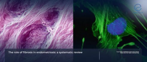 Understanding Fibrosis in Endometriosis