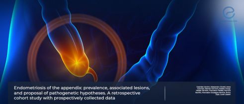 Appendiceal Endometriosis Associated With Ovarian and Bladder Endometriosis