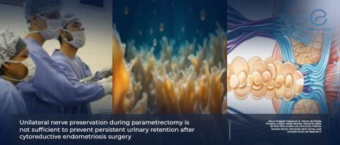  Impact of Nerve Preservation During Parametrectomy on Urinary Retention in Deep Endometriosis Surgery