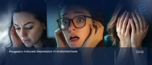 Impact of OC-Induced Mood Lability on Treatment Adherence in Endometriosis