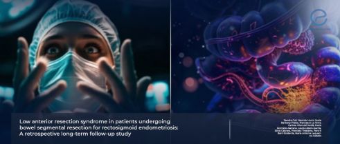 Low Anterior Resection Syndrome (LARS) Risk Following Rectosigmoid Endometriosis Surgery