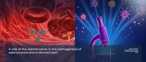 Cervix as a Missing Link in Endometriosis Pathogenesis