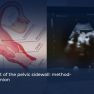 Systematic Approach Could Help Better Diagnose Endometriosis